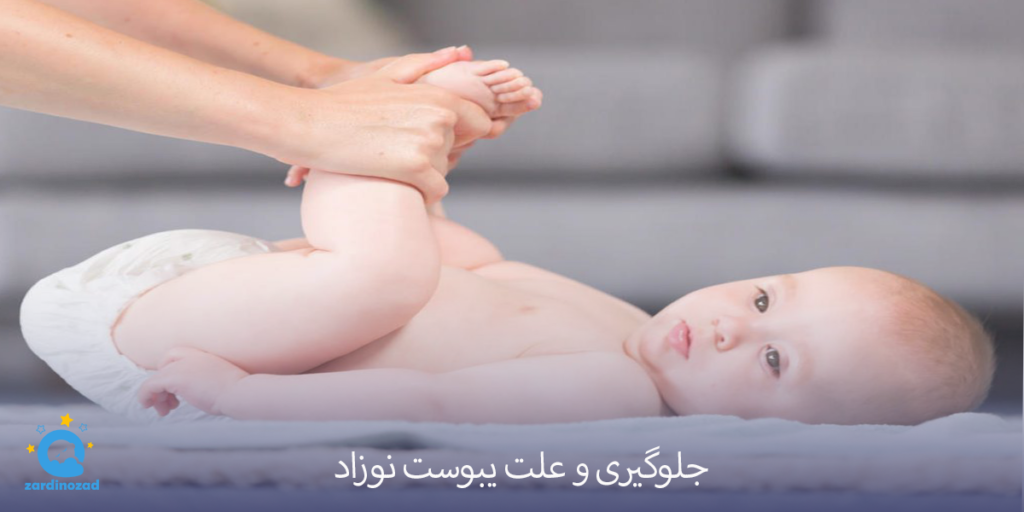 جلوگیری و علت یبوست نوزاد